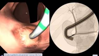 EndoSim Endoscopic Retrograde Cholangiopancreatography  ERCP [upl. by Ecnar]