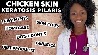 Keratosis Pilaris Chicken Skin  Treating Dry Bumpy Skin  Special Tips for Black Skin  Ask Doctor [upl. by Sims]