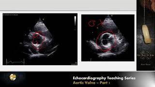 Aortic Aneurysms Risk Screening and Treatment [upl. by Sherborn]