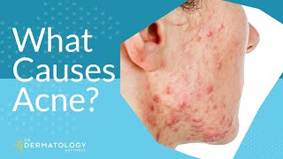 What Causes Acne  Explained by Dermatologist [upl. by Nylek]