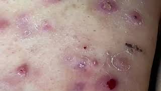 Cystic Acne Cysts Acne Dermatology Comedones and Whiteheads [upl. by Aiuqes]