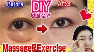 How to Remove Under Eye Bags👁️ Naturally in 7 Days Massage amp Exercises🙋 [upl. by Annavas]