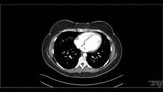 Abdominal Anatomy on Computed Tomography [upl. by Solrak]