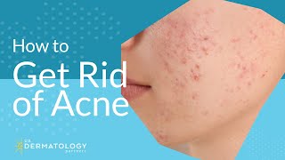 Acne Treatment  Explained by Dermatologist [upl. by Lamrert]