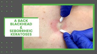 A Back Blackhead amp Seborrheic Keratoses  Dr Derm [upl. by Volnay390]