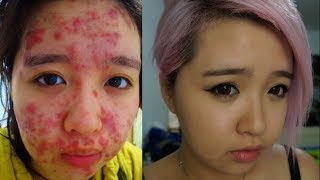 From Severe Acne to Clear Skin [upl. by Nathanial207]