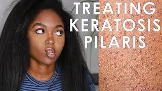 TREATING KERATOSIS PILARIS  3 EASY STEPS [upl. by Colson320]