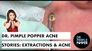 Dr Pimple Popper Acne Stories Extractions amp Acne [upl. by Asusej]