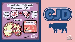 Creutzfeldt Jakob Disease CJD [upl. by Gisela]