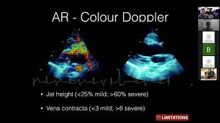 Aortic Regurgitation [upl. by Efi]