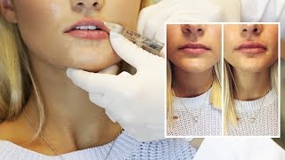 Lip Filler Experience  Start to Finish with 1 Syringe of Juvederm [upl. by Doelling]