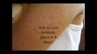 How to cure keratosis pilaris in 4 easy steps [upl. by Tris430]