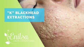 Blackheads Whiteheads Extractions on quotKquot Part 1 [upl. by Pearl]